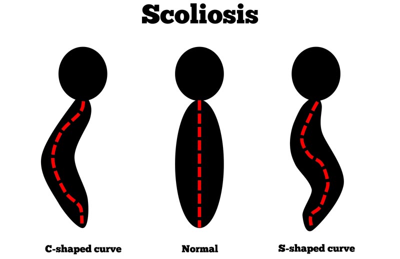 Portland, OR scoliosis treatment